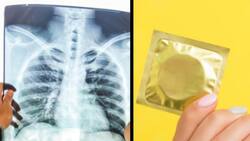 ¿Cómo puede llegar un condón a los pulmones? Encontraron un condón incrustado en el pulmón de una mujer, el caso se hizo viral