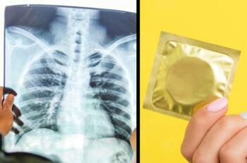 ¿Cómo puede llegar un condón a los pulmones? Encontraron un condón incrustado en el pulmón de una mujer, el caso se hizo viral