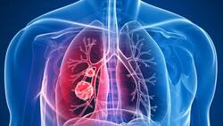 ¿Cómo saber si tengo cáncer de pulmón? Estos son los principales síntomas