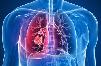 ¿Cómo saber si tengo cáncer de pulmón? Estos son los principales síntomas