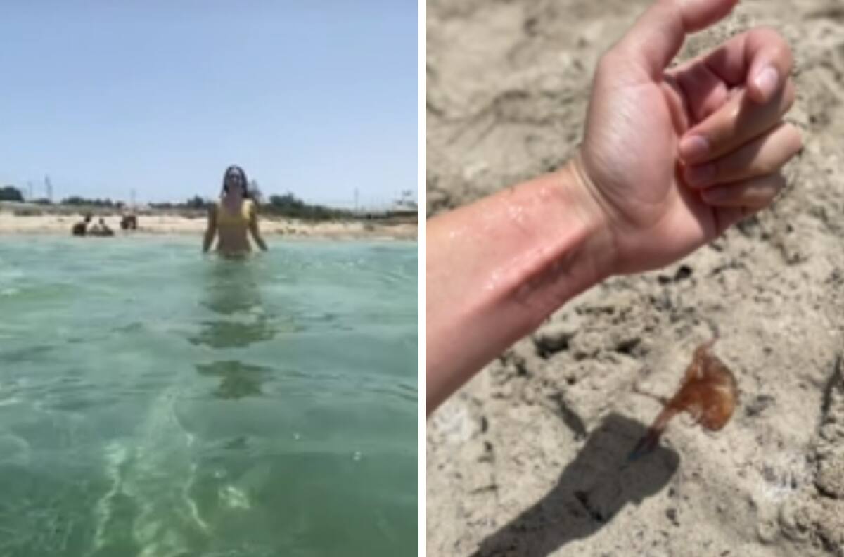 VIDEO| Mujer es picada por una medusa y se vuelve viral