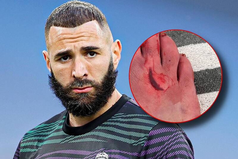 El delantero de Real Madrid Karim Benzemá jugó casi todo un partido con un corte en el pie derecho