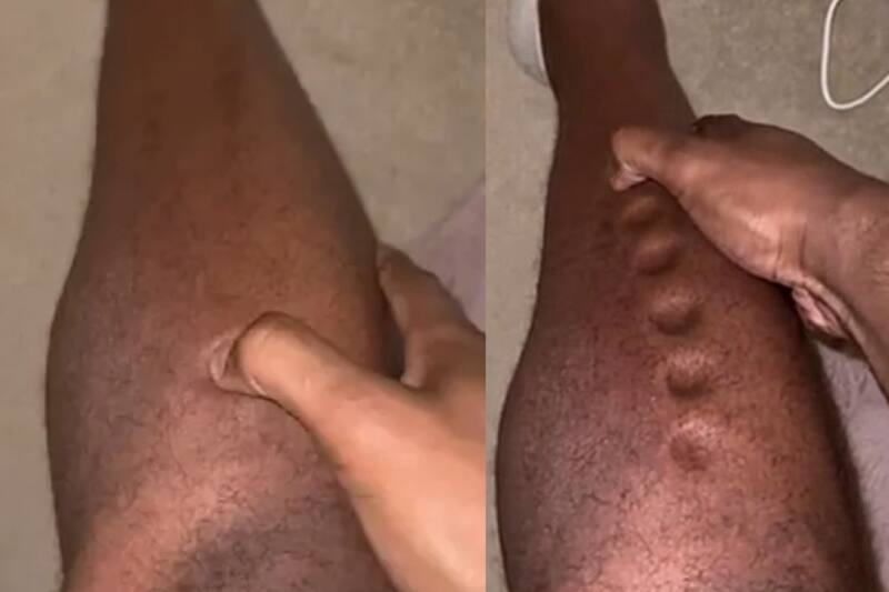 Atleta olímpico muestra sus "agujeros locos" en sus piernas, una extraña forma que tomaba su piel al presionar con su dedo.