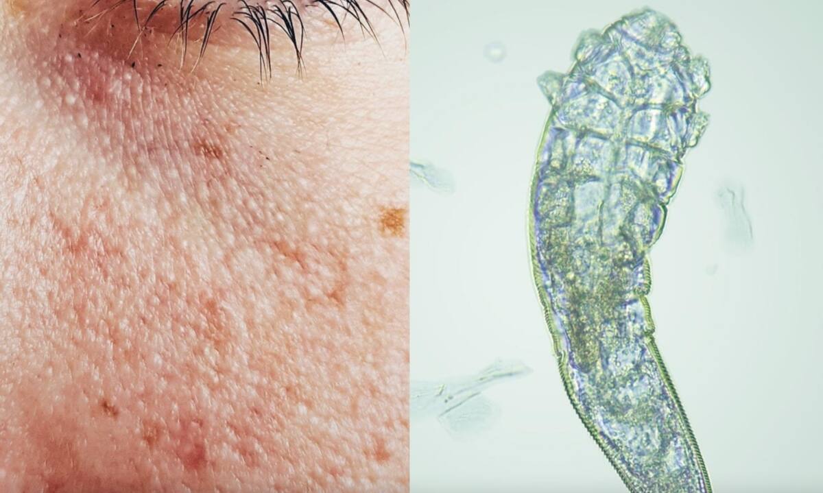 Podrías estarlo confundiendo con el acné (Foto: Twitter)