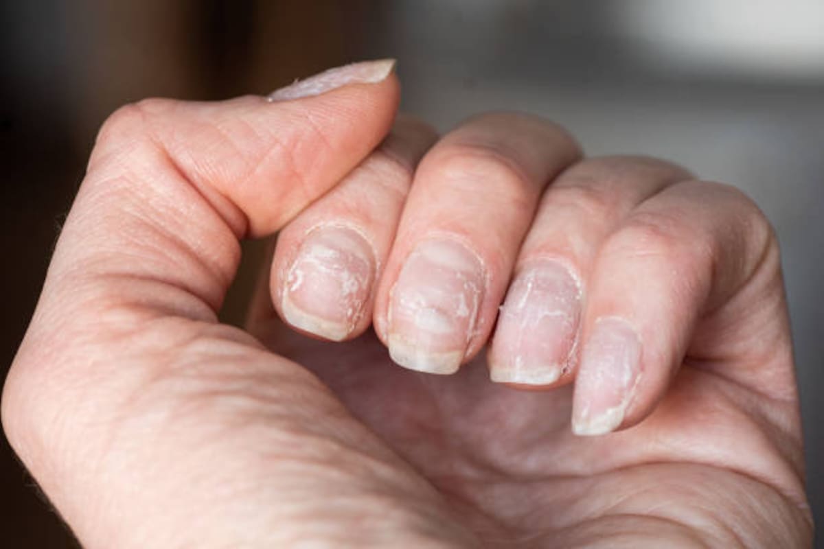 Las uñas pueden sufrir cambios cuándo tienes cierto tipo de cáncer